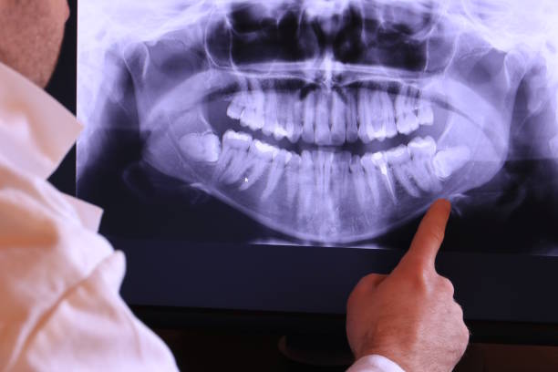 Best Emergency Dentist for Lost Fillings or Crowns in New Bedford, PA